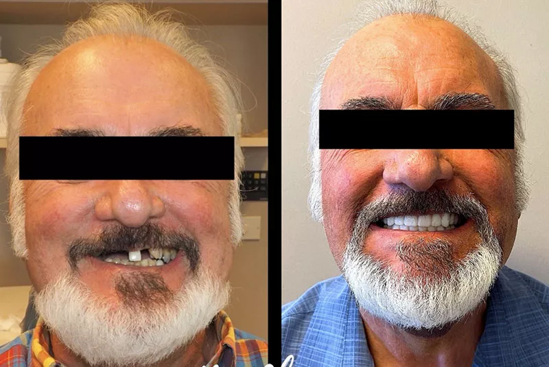 Before After Image