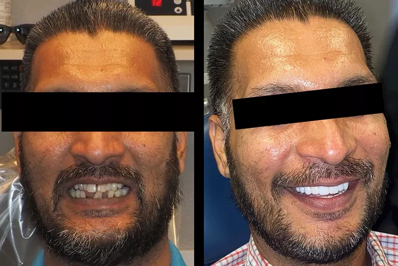 Before After Image