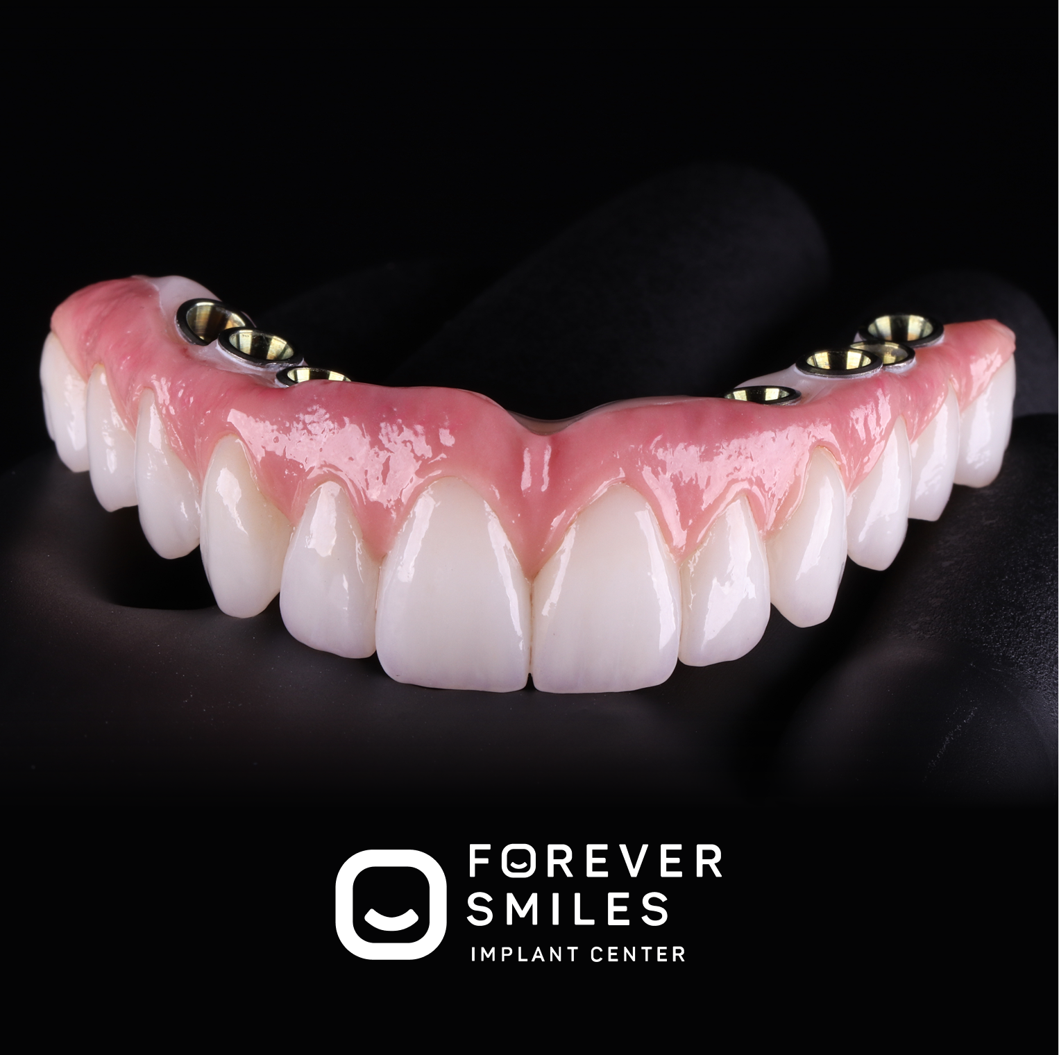 Hybrid Implant Bridge
