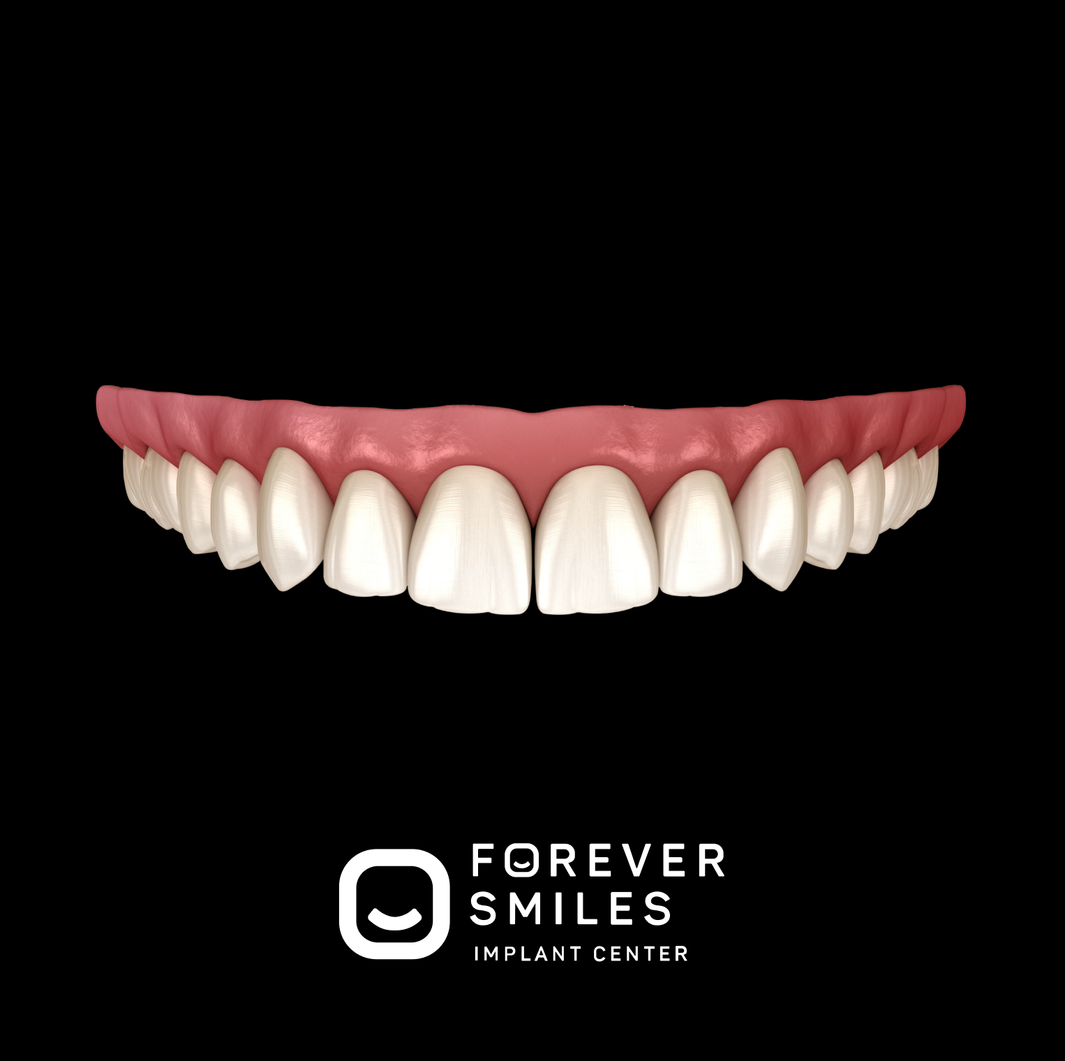 Zirconia Implant Bridge